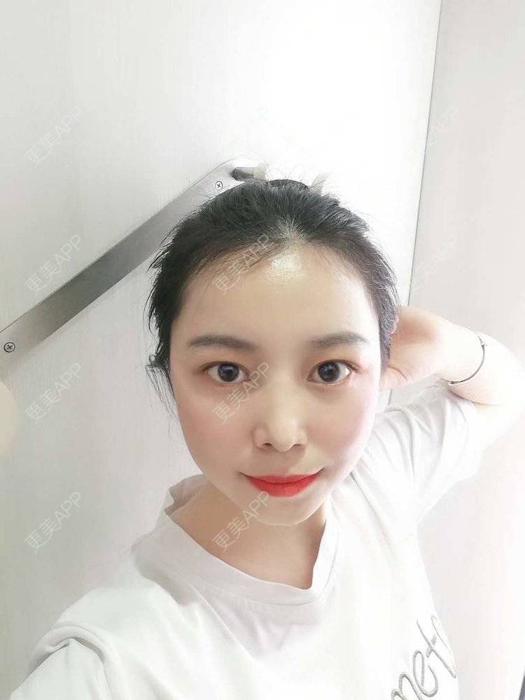 更美 - 更美用户9u5o246DCv的黄金微针经验 | 黄金微针 | 视频日记 | 佛山