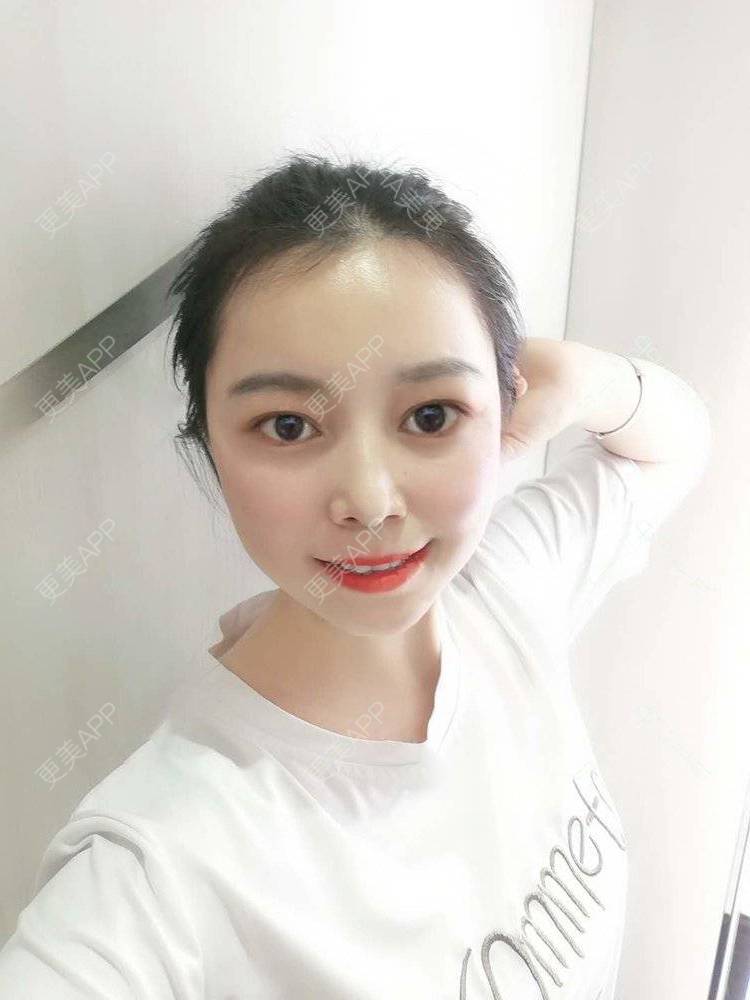 更美 - 更美用户9u5o246DCv的黄金微针经验 | 黄金微针 | 视频日记 | 佛山