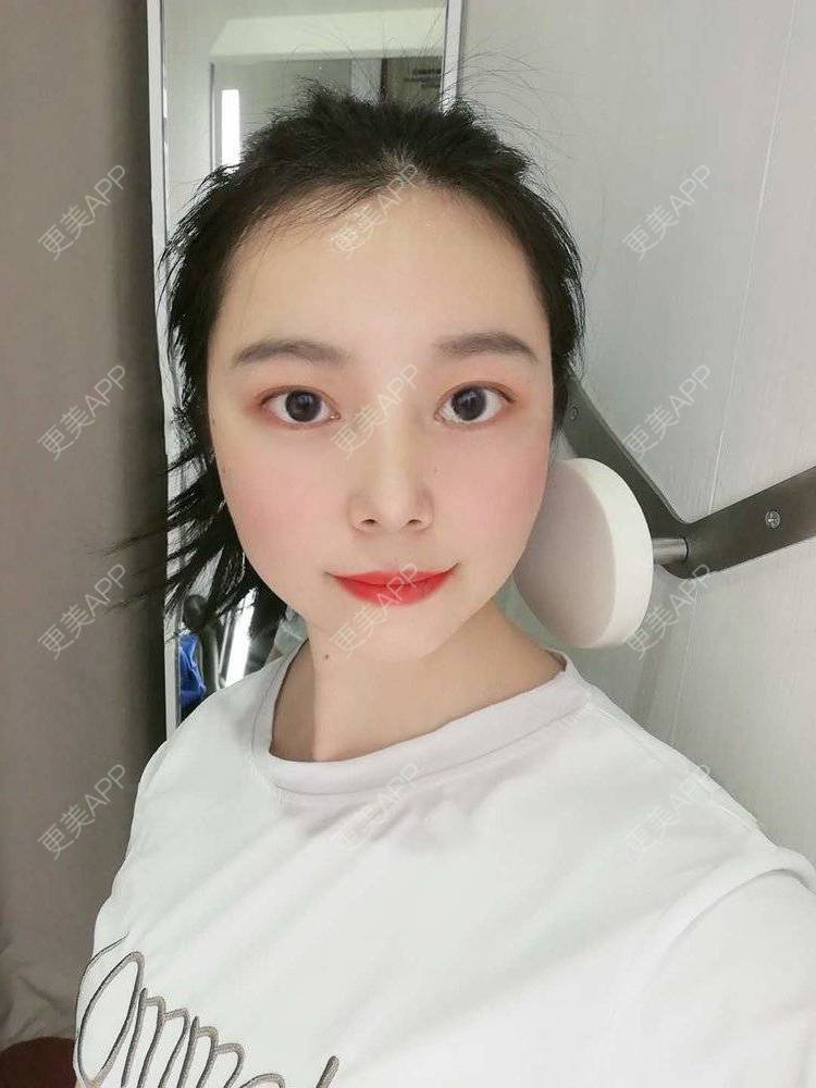 更美 - 更美用户9u5o246DCv的黄金微针经验 | 黄金微针 | 视频日记 | 佛山