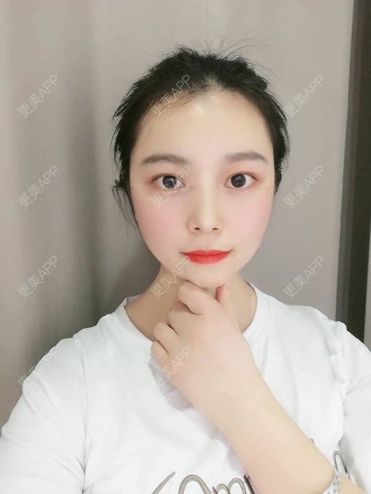 更美 - 更美用户9u5o246DCv的黄金微针经验 | 黄金微针 | 视频日记 | 佛山