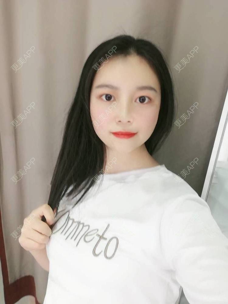 更美 - 更美用户9u5o246DCv的黄金微针经验 | 黄金微针 | 视频日记 | 佛山
