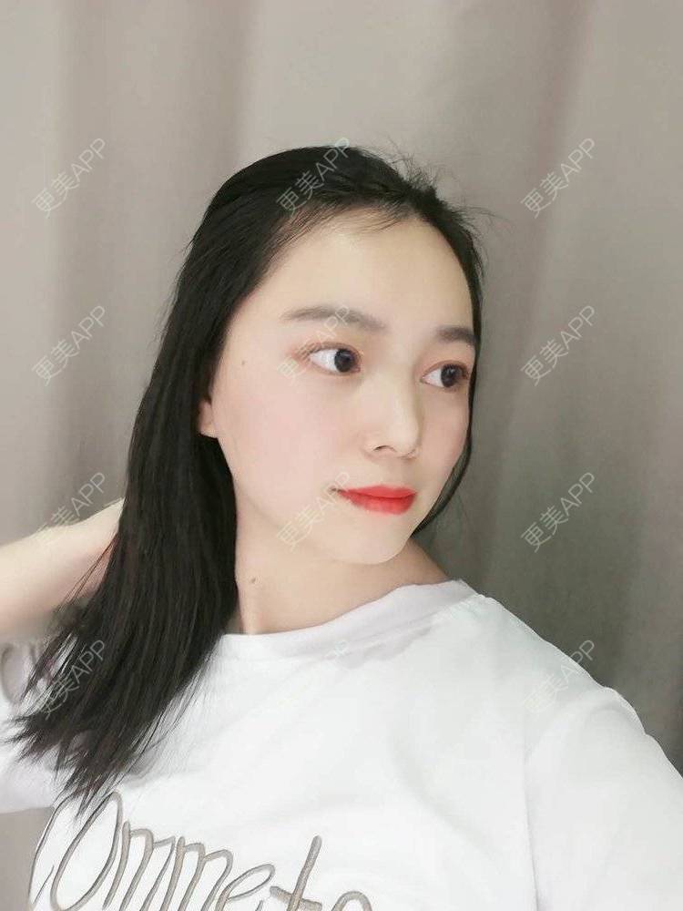 更美 - 更美用户9u5o246DCv的黄金微针经验 | 黄金微针 | 视频日记 | 佛山