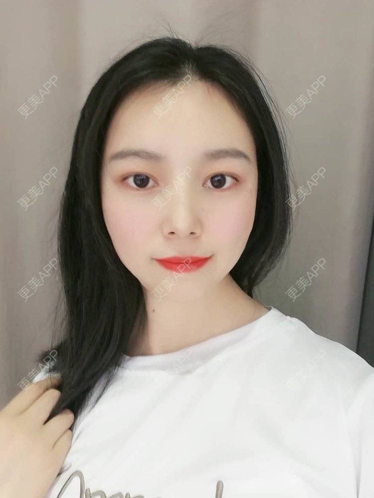 更美 - 更美用户9u5o246DCv的黄金微针经验 | 黄金微针 | 视频日记 | 佛山