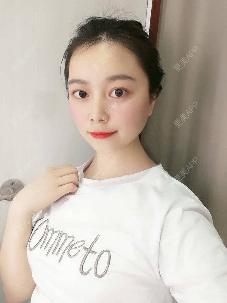 更美 - 更美用户9u5o246DCv的黄金微针经验 | 黄金微针 | 视频日记 | 佛山