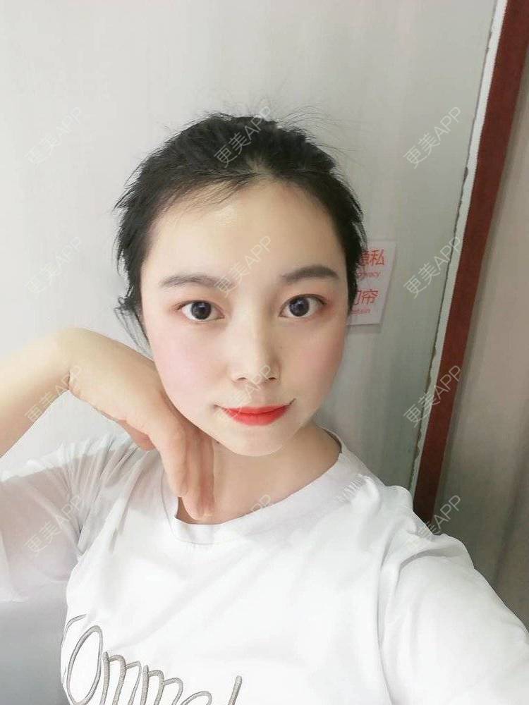 更美 - 更美用户9u5o246DCv的黄金微针经验 | 黄金微针 | 视频日记 | 佛山