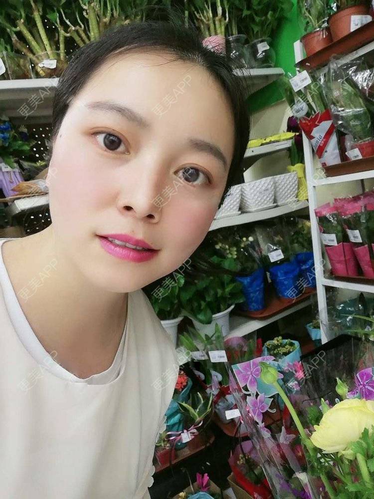 更美 - 更美用户9u5o246DCv的黄金微针经验 | 黄金微针 | 视频日记 | 佛山