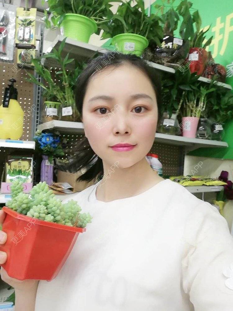 更美 - 更美用户9u5o246DCv的黄金微针经验 | 黄金微针 | 视频日记 | 佛山