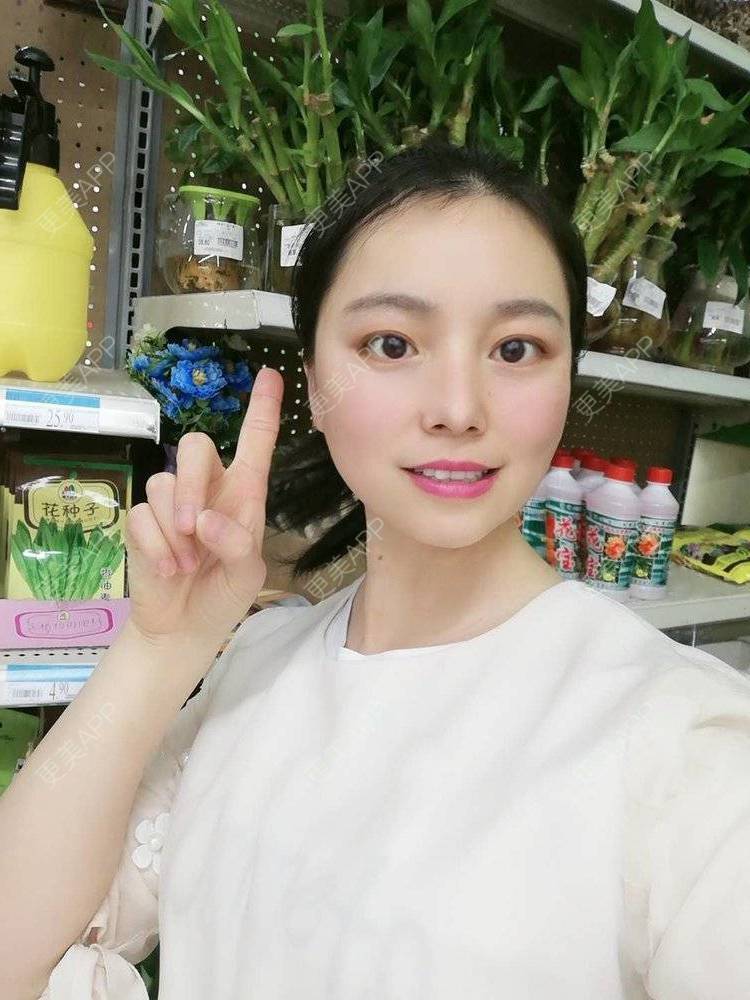 更美 - 更美用户9u5o246DCv的黄金微针经验 | 黄金微针 | 视频日记 | 佛山