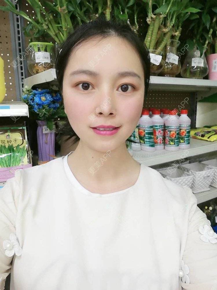 更美 - 更美用户9u5o246DCv的黄金微针经验 | 黄金微针 | 视频日记 | 佛山