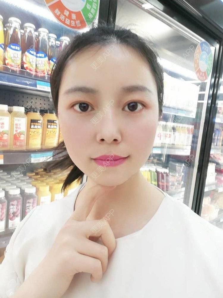 更美 - 更美用户9u5o246DCv的黄金微针经验 | 黄金微针 | 视频日记 | 佛山