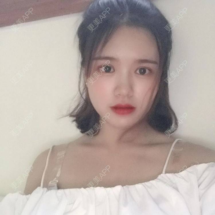 更美 - ︶ㄣ豬見愁℡恃的上眼睑去脂经验 | 上眼睑去脂 | 长沙