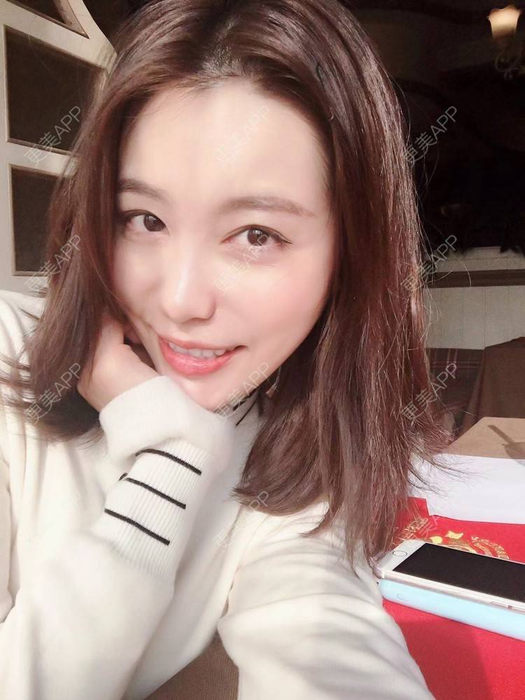 更美 - 更美用户ALoUaZKIrz的自体脂肪填充泪沟经验 | 自体脂肪全面部填充 | 自体脂肪丰额头 | 自体脂肪丰太阳穴 | 自体脂肪填充泪沟 | 自体脂肪丰唇 | 自体脂肪丰面颊