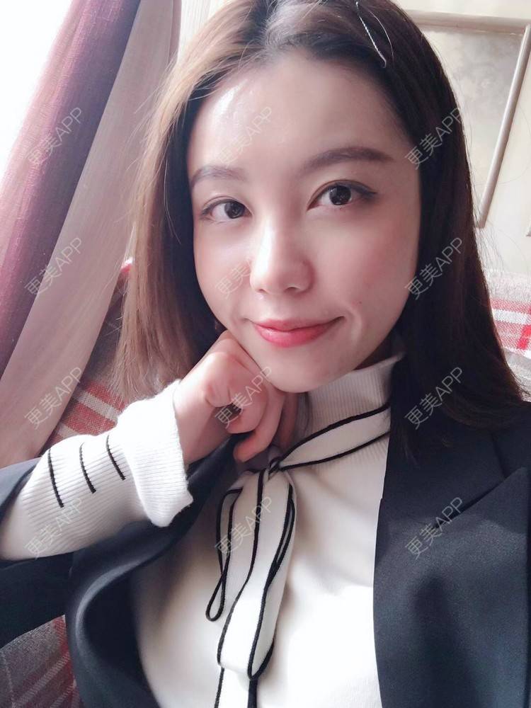 更美 - 更美用户ALoUaZKIrz的自体脂肪填充泪沟经验 | 自体脂肪全面部填充 | 自体脂肪丰额头 | 自体脂肪丰太阳穴 | 自体脂肪填充泪沟 | 自体脂肪丰唇 | 自体脂肪丰面颊