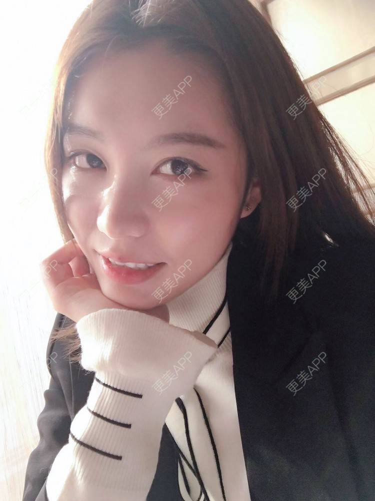 更美 - 更美用户ALoUaZKIrz的自体脂肪填充泪沟经验 | 自体脂肪全面部填充 | 自体脂肪丰额头 | 自体脂肪丰太阳穴 | 自体脂肪填充泪沟 | 自体脂肪丰唇 | 自体脂肪丰面颊