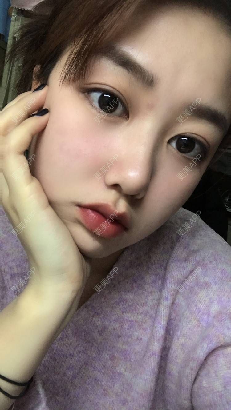 更美用户BS4eCXyV6i的微创双眼皮日记