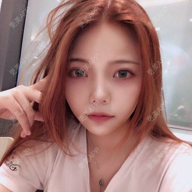 更美 - . Kylla rrrrr🔻的玻尿酸下巴经验 | 玻尿酸下巴 | 上海 | 玻尿酸面颊