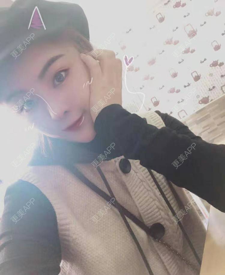 更美 - 静静j的自体脂肪丰额头经验 | 上海 | 自体脂肪丰额头