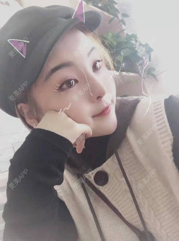 更美 - 静静j的自体脂肪丰额头经验 | 上海 | 自体脂肪丰额头