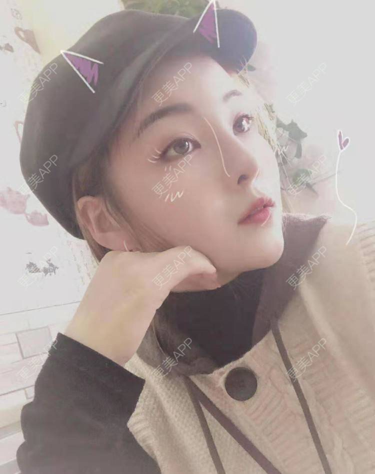 更美 - 静静j的自体脂肪丰额头经验 | 上海 | 自体脂肪丰额头