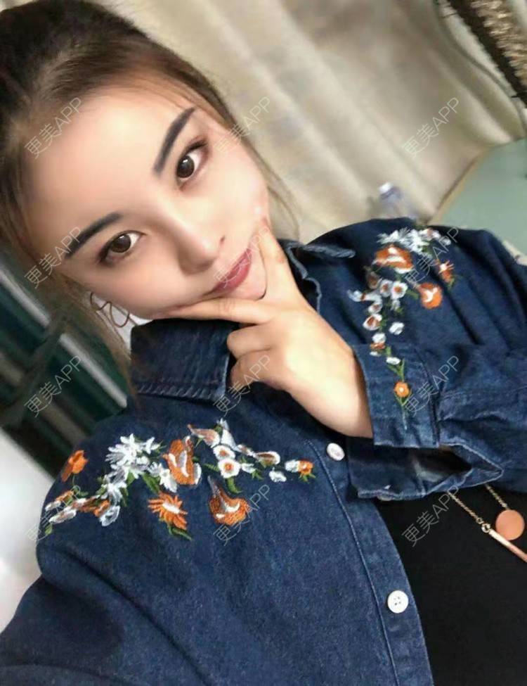 更美 - 静静j的自体脂肪丰额头经验 | 上海 | 自体脂肪丰额头