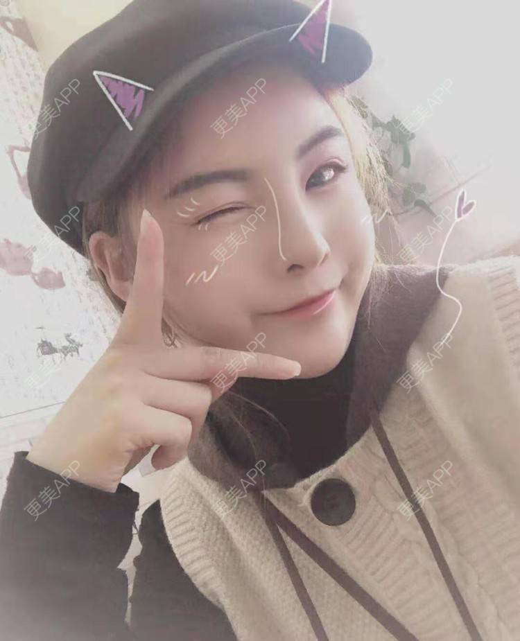 更美 - 静静j的自体脂肪丰额头经验 | 上海 | 自体脂肪丰额头