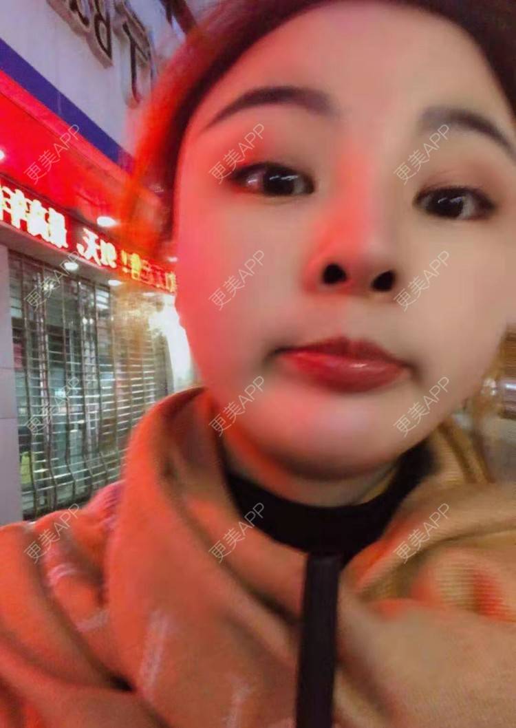 更美 - 静静j的自体脂肪丰额头经验 | 上海 | 自体脂肪丰额头