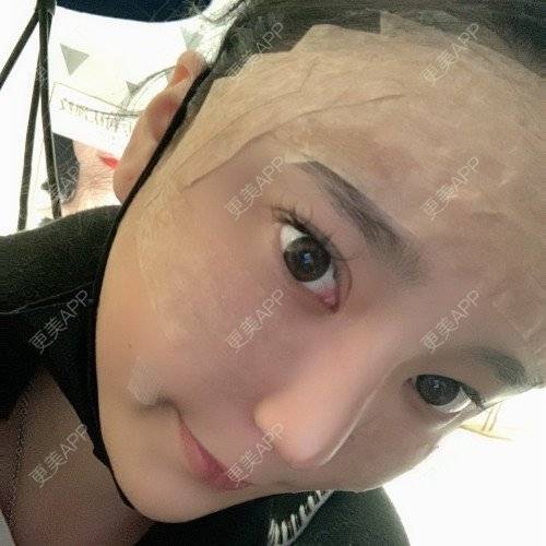 更美 - 更美用户iUgxHIc5fy的自体脂肪丰苹果肌经验 | 自体脂肪丰苹果肌 | 自体脂肪丰太阳穴 | 自体脂肪丰额头 | 武汉