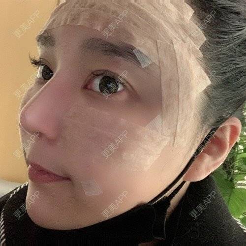 更美 - 更美用户iUgxHIc5fy的自体脂肪丰苹果肌经验 | 自体脂肪丰苹果肌 | 自体脂肪丰太阳穴 | 自体脂肪丰额头 | 武汉
