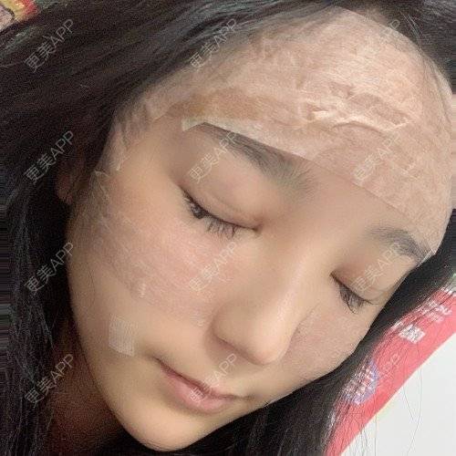 更美 - 更美用户iUgxHIc5fy的自体脂肪丰苹果肌经验 | 自体脂肪丰苹果肌 | 自体脂肪丰太阳穴 | 自体脂肪丰额头 | 武汉