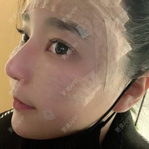 更美 - 更美用户iUgxHIc5fy的自体脂肪丰苹果肌经验 | 自体脂肪丰苹果肌 | 自体脂肪丰太阳穴 | 自体脂肪丰额头 | 武汉
