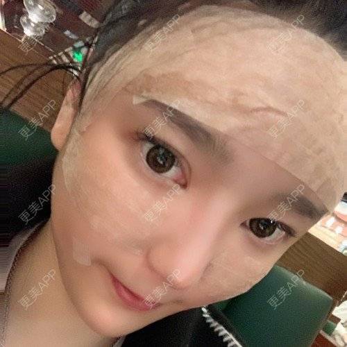 更美 - 更美用户iUgxHIc5fy的自体脂肪丰苹果肌经验 | 自体脂肪丰苹果肌 | 自体脂肪丰太阳穴 | 自体脂肪丰额头 | 武汉