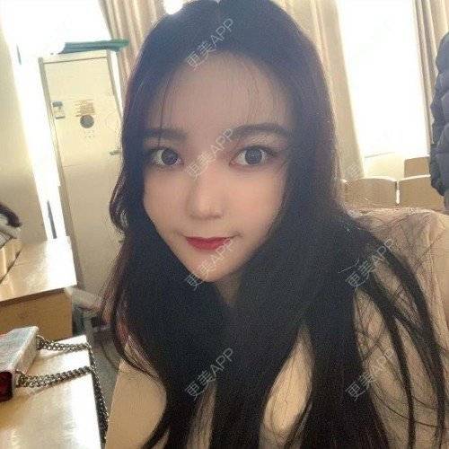 更美 - 更美用户iUgxHIc5fy的自体脂肪丰苹果肌经验 | 自体脂肪丰苹果肌 | 自体脂肪丰太阳穴 | 自体脂肪丰额头 | 武汉