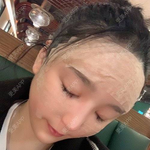 更美 - 更美用户iUgxHIc5fy的自体脂肪丰苹果肌经验 | 自体脂肪丰苹果肌 | 自体脂肪丰太阳穴 | 自体脂肪丰额头 | 武汉