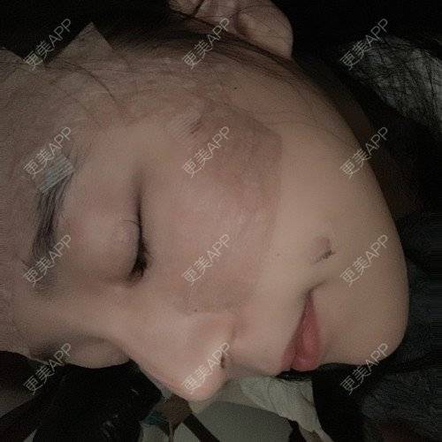 更美 - 更美用户iUgxHIc5fy的自体脂肪丰苹果肌经验 | 自体脂肪丰苹果肌 | 自体脂肪丰太阳穴 | 自体脂肪丰额头 | 武汉