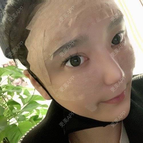 更美 - 更美用户iUgxHIc5fy的自体脂肪丰苹果肌经验 | 自体脂肪丰苹果肌 | 自体脂肪丰太阳穴 | 自体脂肪丰额头 | 武汉