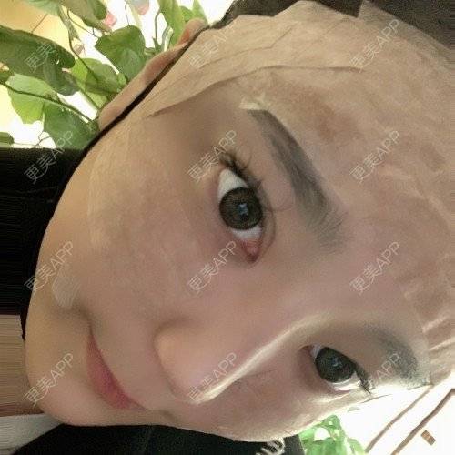 更美 - 更美用户iUgxHIc5fy的自体脂肪丰苹果肌经验 | 自体脂肪丰苹果肌 | 自体脂肪丰太阳穴 | 自体脂肪丰额头 | 武汉