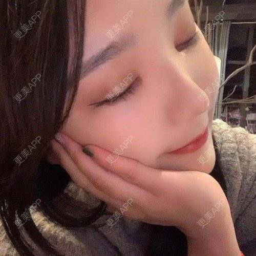 更美 - 更美用户iUgxHIc5fy的自体脂肪丰苹果肌经验 | 自体脂肪丰苹果肌 | 自体脂肪丰太阳穴 | 自体脂肪丰额头 | 武汉