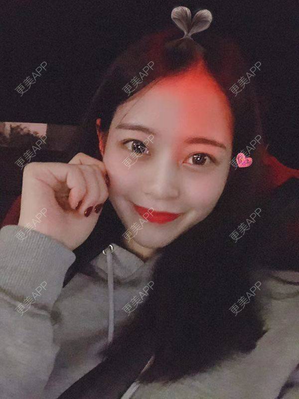 更美 - 更美用户bReM8VHHCF的激光淡化黑眼圈经验 | 视频日记 | 深圳 | 激光淡化黑眼圈