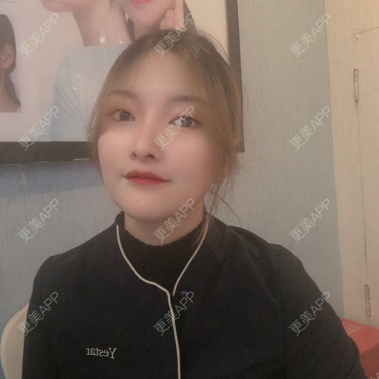 更美 - 更美用户Qx4QKwu9t2的手术缩鼻头经验 | 手术缩鼻头 | 鼻小柱延长 | 自体软骨垫鼻尖 | 长沙
