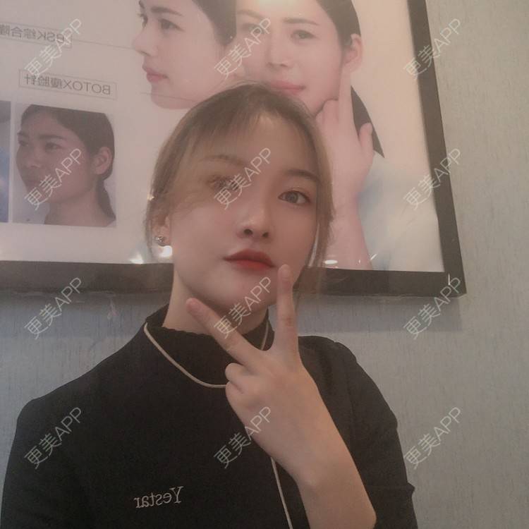 更美 - 更美用户Qx4QKwu9t2的手术缩鼻头经验 | 手术缩鼻头 | 鼻小柱延长 | 自体软骨垫鼻尖 | 长沙