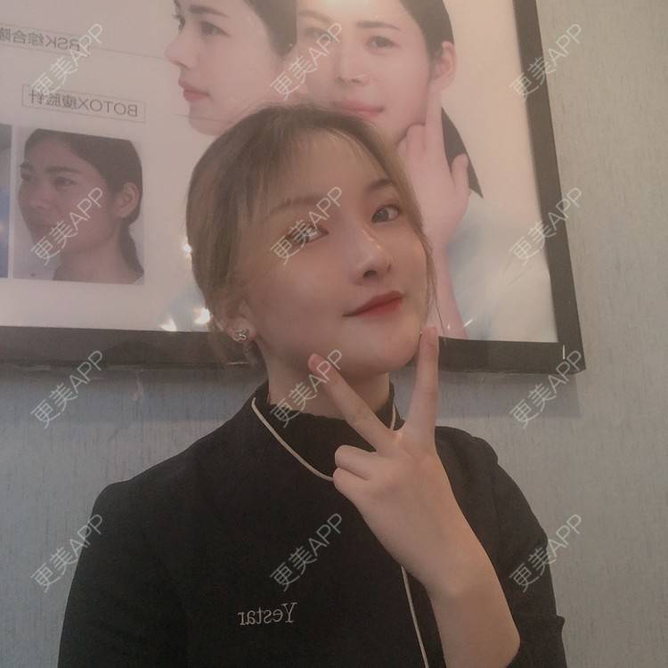 更美 - 更美用户Qx4QKwu9t2的手术缩鼻头经验 | 手术缩鼻头 | 鼻小柱延长 | 自体软骨垫鼻尖 | 长沙