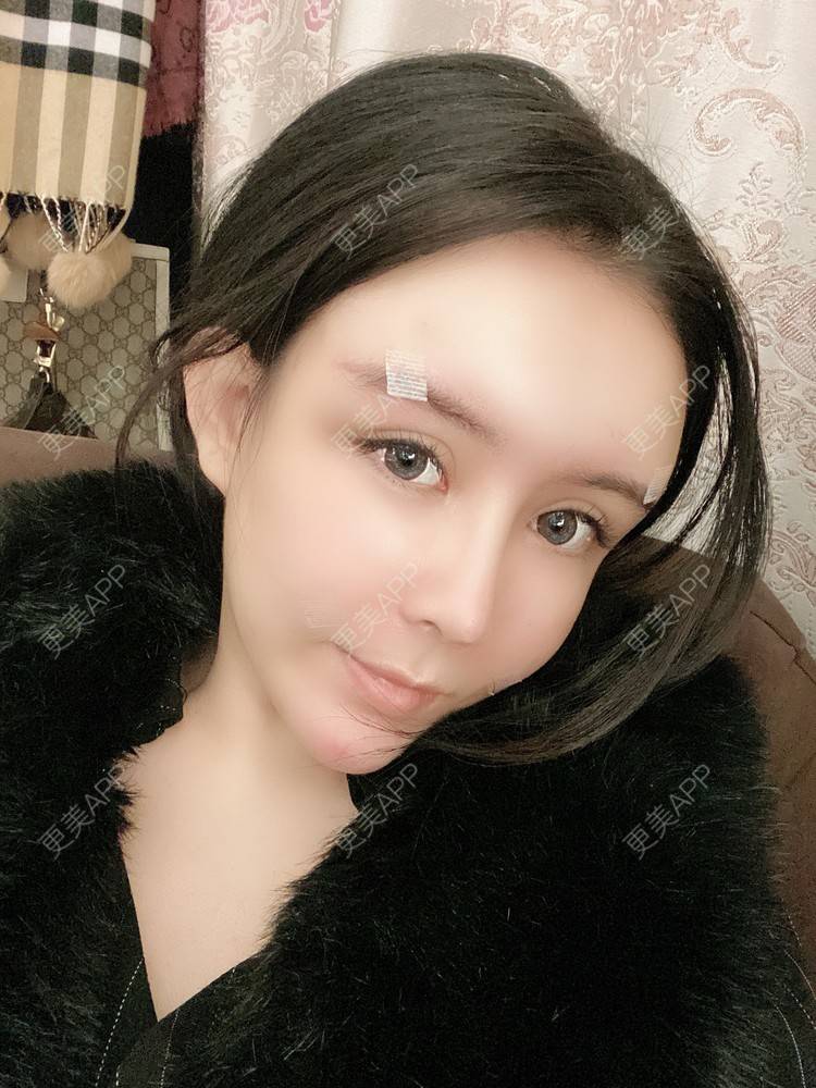 更美 - 更美用户XbSPRKDbDj的自体脂肪填充泪沟经验 | 自体脂肪丰额头 | 自体脂肪丰苹果肌 | 自体脂肪丰太阳穴 | 自体脂肪垫眉弓 | 自体脂肪填充泪沟 | 武汉