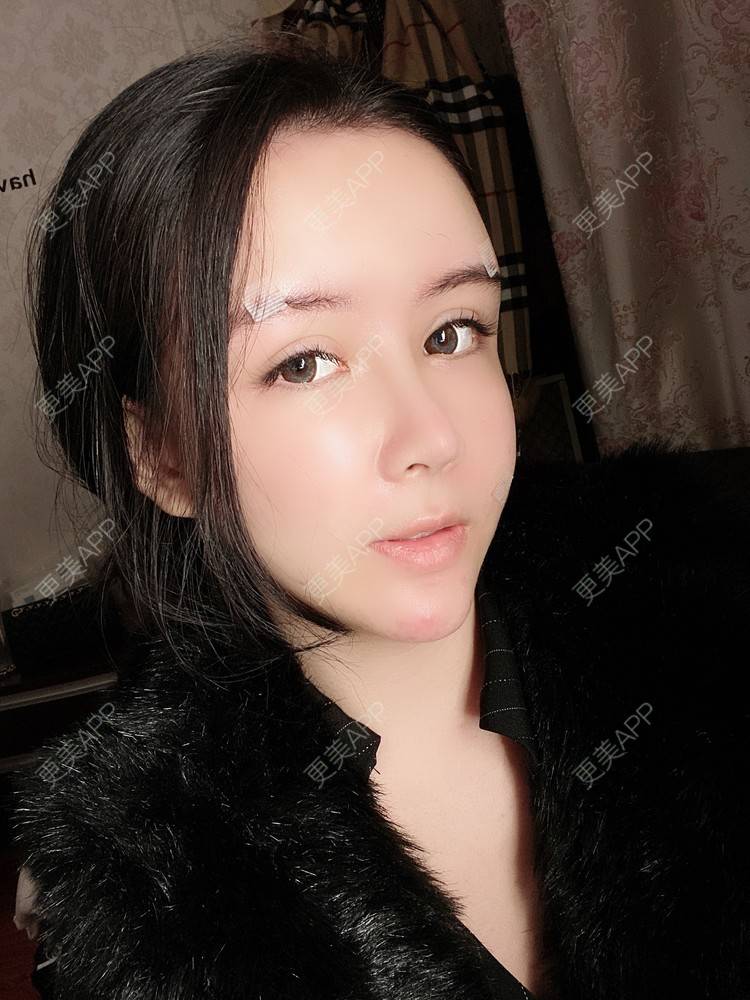 更美 - 更美用户XbSPRKDbDj的自体脂肪填充泪沟经验 | 自体脂肪丰额头 | 自体脂肪丰苹果肌 | 自体脂肪丰太阳穴 | 自体脂肪垫眉弓 | 自体脂肪填充泪沟 | 武汉