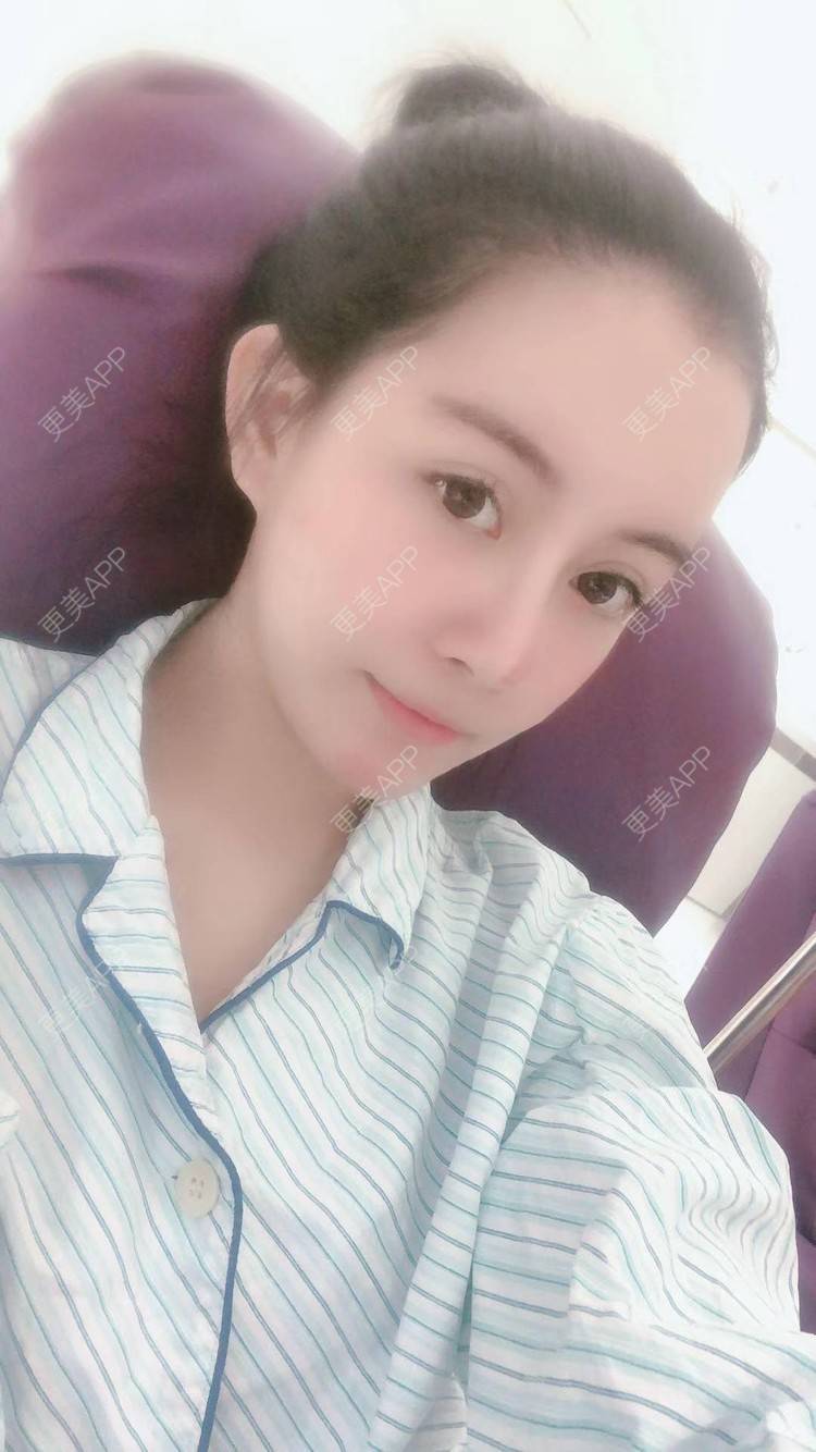 更美 - 更美用户XbSPRKDbDj的自体脂肪填充泪沟经验 | 自体脂肪丰额头 | 自体脂肪丰苹果肌 | 自体脂肪丰太阳穴 | 自体脂肪垫眉弓 | 自体脂肪填充泪沟 | 武汉