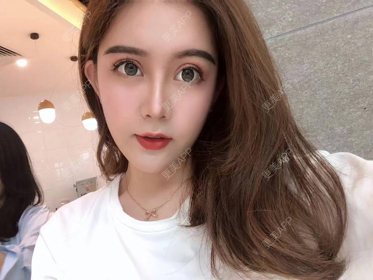 更美 - 更美用户XbSPRKDbDj的自体脂肪填充泪沟经验 | 自体脂肪丰额头 | 自体脂肪丰苹果肌 | 自体脂肪丰太阳穴 | 自体脂肪垫眉弓 | 自体脂肪填充泪沟 | 武汉
