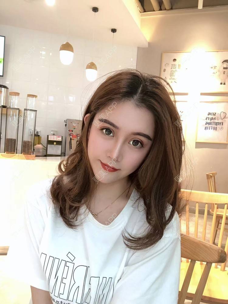 更美 - 更美用户XbSPRKDbDj的自体脂肪填充泪沟经验 | 自体脂肪丰额头 | 自体脂肪丰苹果肌 | 自体脂肪丰太阳穴 | 自体脂肪垫眉弓 | 自体脂肪填充泪沟 | 武汉