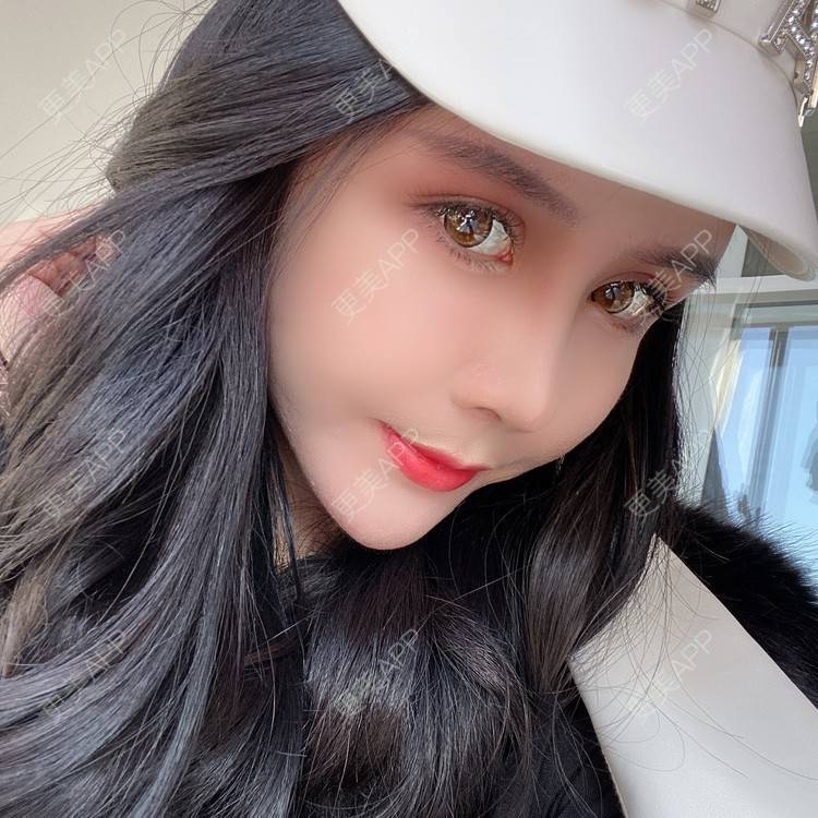 更美 - 更美用户XbSPRKDbDj的自体脂肪填充泪沟经验 | 自体脂肪丰额头 | 自体脂肪丰苹果肌 | 自体脂肪丰太阳穴 | 自体脂肪垫眉弓 | 自体脂肪填充泪沟 | 武汉