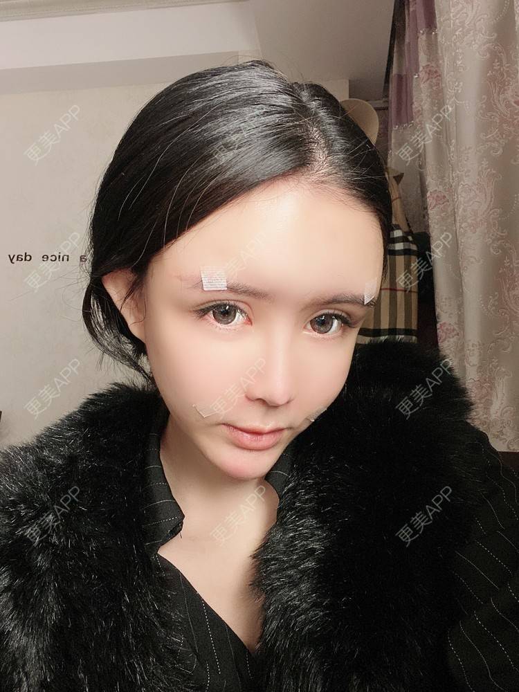 更美 - 更美用户XbSPRKDbDj的自体脂肪填充泪沟经验 | 自体脂肪丰额头 | 自体脂肪丰苹果肌 | 自体脂肪丰太阳穴 | 自体脂肪垫眉弓 | 自体脂肪填充泪沟 | 武汉