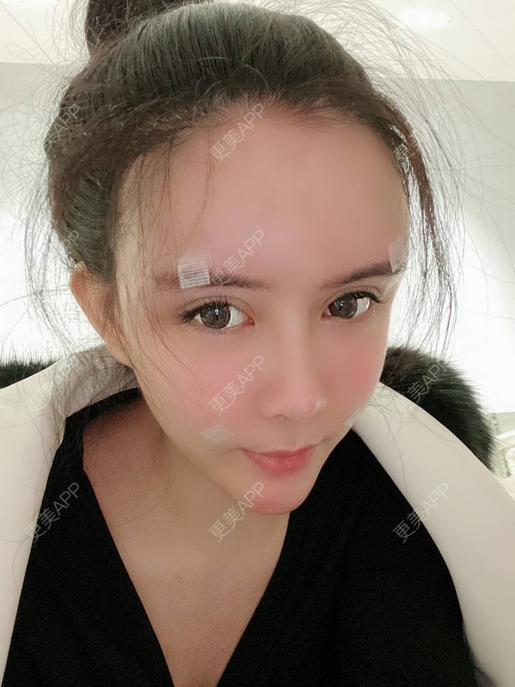 更美 - 更美用户XbSPRKDbDj的自体脂肪填充泪沟经验 | 自体脂肪丰额头 | 自体脂肪丰苹果肌 | 自体脂肪丰太阳穴 | 自体脂肪垫眉弓 | 自体脂肪填充泪沟 | 武汉