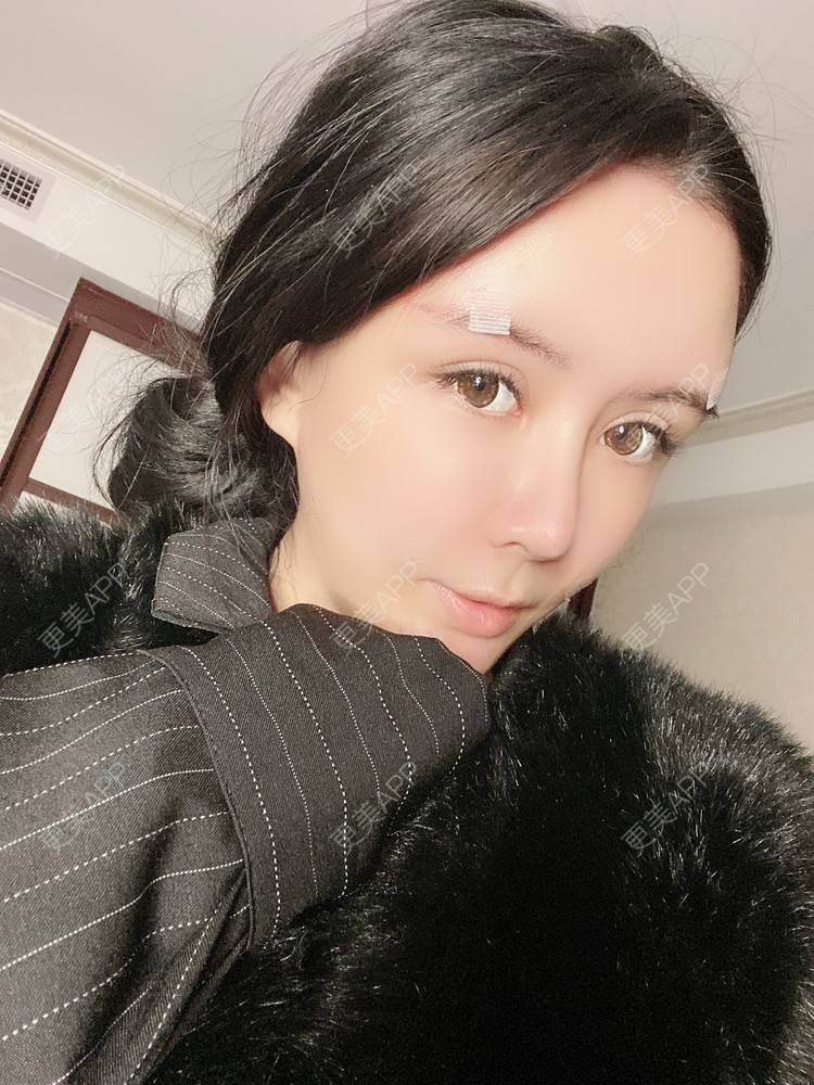 更美 - 更美用户XbSPRKDbDj的自体脂肪填充泪沟经验 | 自体脂肪丰额头 | 自体脂肪丰苹果肌 | 自体脂肪丰太阳穴 | 自体脂肪垫眉弓 | 自体脂肪填充泪沟 | 武汉